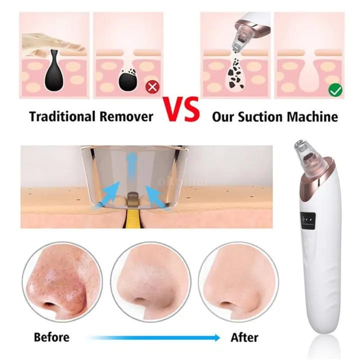 Face Vacuum Blackhead Remover